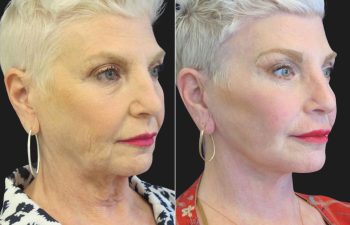 59 year-old facelift, neck lift, upper and lower blepharoplasty, brow lift, facial fat grafting, CO2 Laser, and skincare treatment.