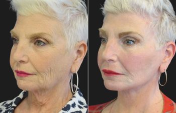 59 year-old facelift, neck lift, upper and lower blepharoplasty, brow lift, facial fat grafting, CO2 Laser, and skincare treatment.