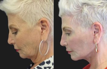 59 year-old facelift, neck lift, upper and lower blepharoplasty, brow lift, facial fat grafting, CO2 Laser, and skincare treatment.