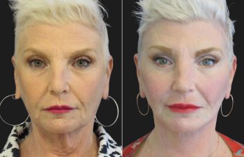 59 year-old facelift, neck lift, upper and lower blepharoplasty, brow lift, facial fat grafting, CO2 Laser, and skincare treatment.