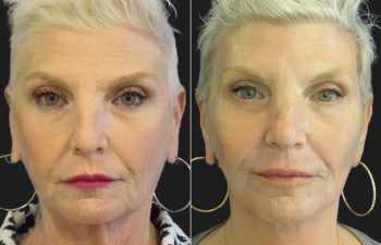 59 year-old facelift, neck lift, upper and lower blepharoplasty, brow lift, facial fat grafting, CO2 Laser, and skincare treatment.