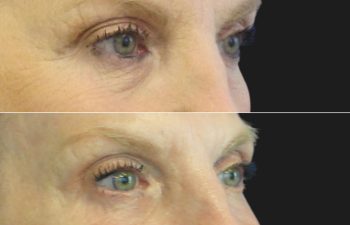 59 year-old facelift, neck lift, upper and lower blepharoplasty, brow lift, facial fat grafting, CO2 Laser, and skincare treatment.