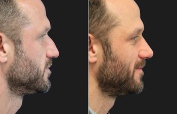 45 year-old male patient before and 6 months after rhinoplasty and septoplasty combination