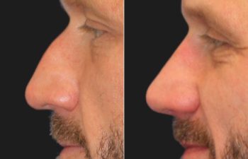 45 year-old male before and 6 months after rhinoplasty and septoplasty combination