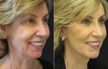 66 year-old before and after a facelift, neck lift, upper and lower blepharoplasty, brow lift, facial fat grafting, TCA Peel and skincare treatment