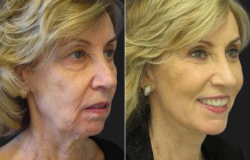 66 year-old before and after a facelift, neck lift, upper and lower blepharoplasty, brow lift, facial fat grafting, TCA Peel and skincare treatment