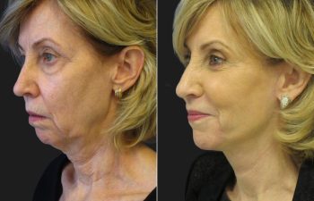 66 year-old before and after a facelift, neck lift, upper and lower blepharoplasty, brow lift, facial fat grafting, TCA Peel and skincare treatment