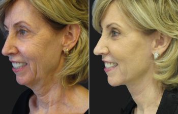 66 year-old before and after a facelift, neck lift, upper and lower blepharoplasty, brow lift, facial fat grafting, TCA Peel and skincare treatment