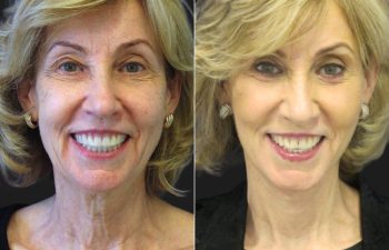 66 year-old before and after a facelift, neck lift, upper and lower blepharoplasty, brow lift, facial fat grafting, TCA Peel and skincare treatment