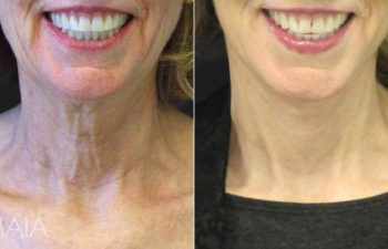 66 year-old before and after a facelift, neck lift, upper and lower blepharoplasty, brow lift, facial fat grafting, TCA Peel and skincare treatment