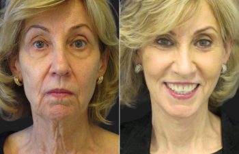 66 year-old before and after a facelift, neck lift, upper and lower blepharoplasty, brow lift, facial fat grafting, TCA Peel and skincare treatment