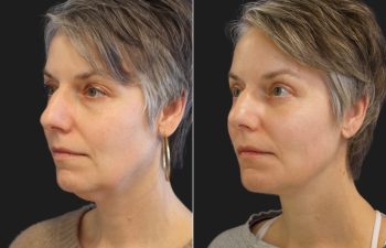 49 year-old before and after Facelift, Necklift, Lower Blepharoplasty, Fat Grafting to Face