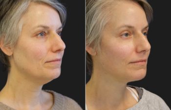 49 year-old before and after Facelift, Necklift, Lower Blepharoplasty, Fat Grafting to Face