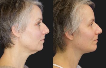 49 year-old before and after Facelift, Necklift, Lower Blepharoplasty, Fat Grafting to Face