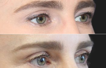 43 year-old patient before and 2 weeks after an upper eyelid lift and mini brow lift