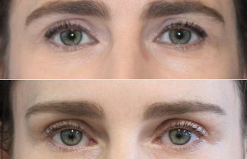 43 year-old patient before and 2 weeks after an upper eyelid lift and mini brow lift