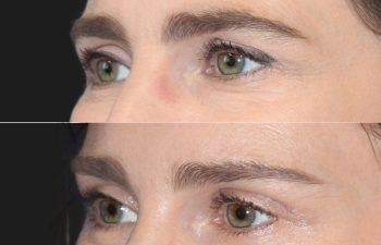 43 year-old patient before and 2 weeks after an upper eyelid lift and mini brow lift