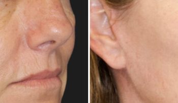 47 year-old patient before and 5 months after CO2 laser combined with facial rejuvenation surgery