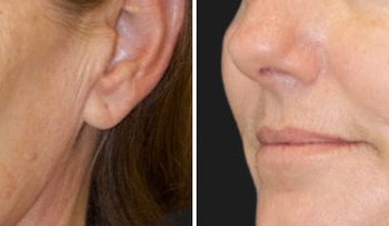 47 year-old patient before and 5 months after CO2 laser combined with facial rejuvenation surgery