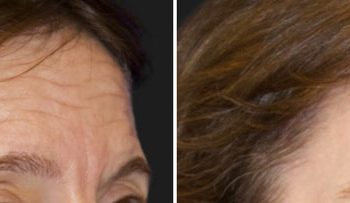 47 year-old patient before and 5 months after CO2 laser combined with facial rejuvenation surgery