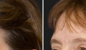 47 year-old patient before and 5 months after CO2 laser combined with facial rejuvenation surgery