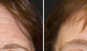 47 year-old patient before and 5 months after CO2 laser combined with facial rejuvenation surgery