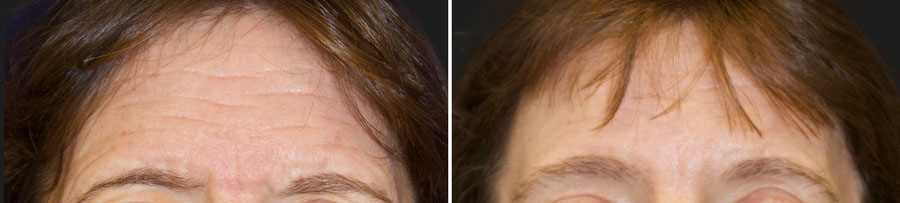 47 year-old patient before and 5 months after CO2 laser combined with facial rejuvenation surgery