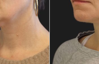 49 year-old before and after Facelift, Necklift, Lower Blepharoplasty, Fat Grafting to Face