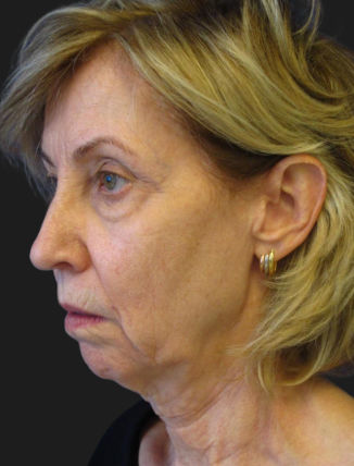 before Facelift & Neck Lift (Custom Facial Rejuvenation)