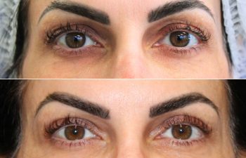43 year-old before and 1 month after an awake upper eyelid lift