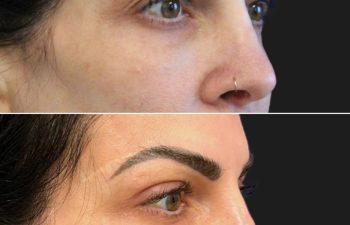 43 year-old before and 1 month after an awake upper eyelid lift