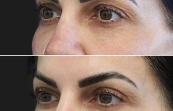 43 year-old before and 1 month after an awake upper eyelid lift
