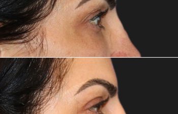 43 year-old before and 1 month after an awake upper eyelid lift