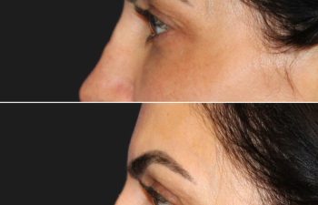43 year-old before and 1 month after an awake upper eyelid lift