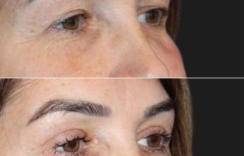 53 year-old before and 7 weeks after an upper eyelid lift