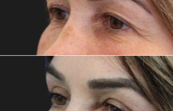 53 year-old before and 7 weeks after an upper eyelid lift