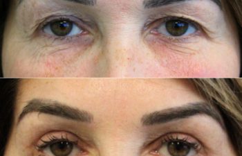53 year-old before and 7 weeks after an upper eyelid lift