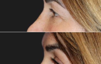 53 year-old before and 7 weeks after an upper eyelid lift