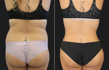 47 year-old mother of 2 before and 2.5 months after a tummy tuck and flank liposuction
