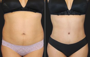 47 year-old mother of 2 before and 2.5 months after a tummy tuck and flank liposuction