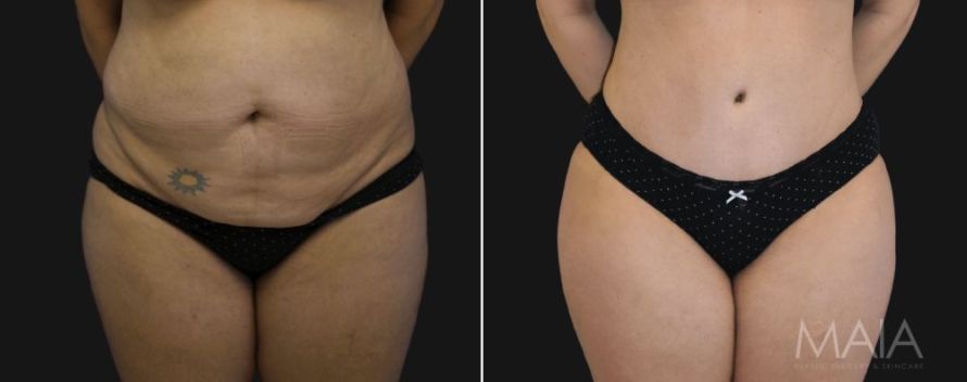 Female patient before and after tummy tuck surgery at Maia Plastic Surgery