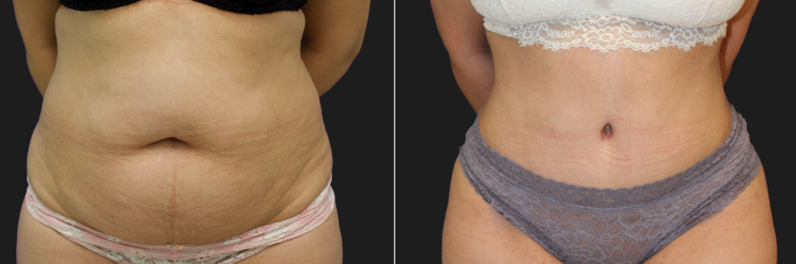 Female patient before and after tummy tuck surgery at Maia Plastic Surgery