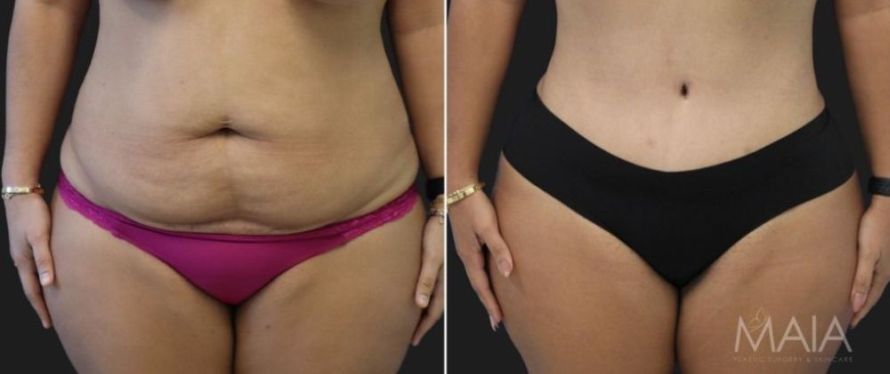 Female patient before and after tummy tuck surgery at Maia Plastic Surgery
