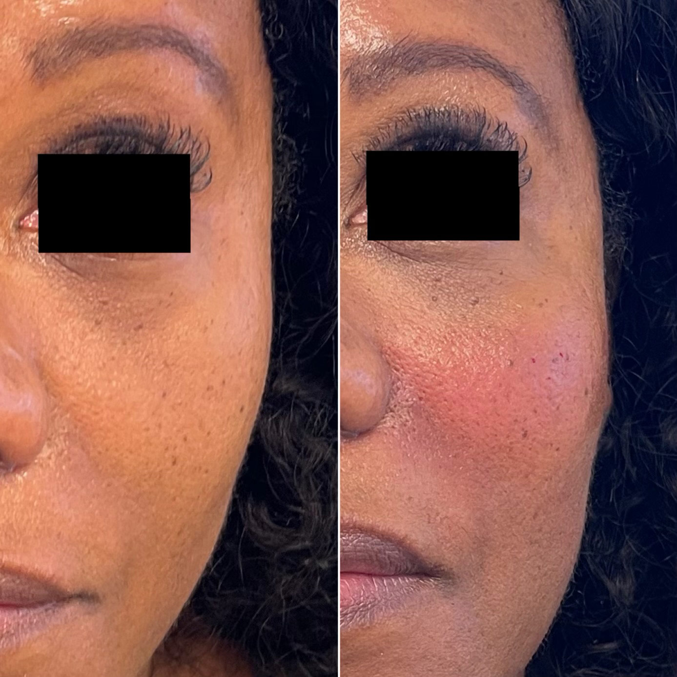 Before and Immediately after Cheek Filler