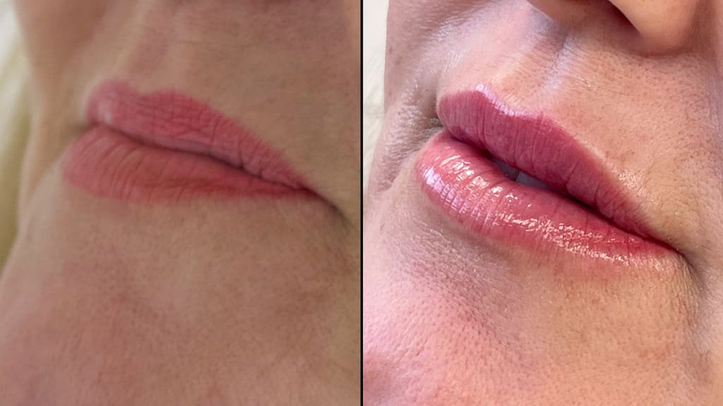 Before and After Lip Filler with Dr. Maia