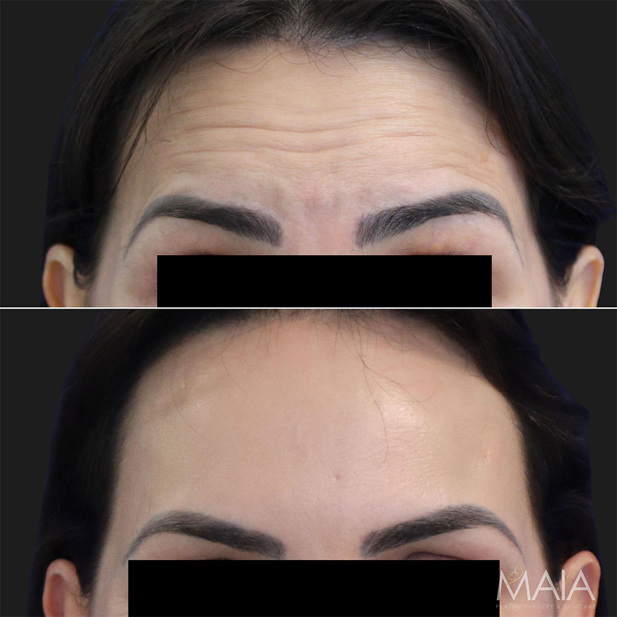Before and 2 weeks after Botox to the Forehead