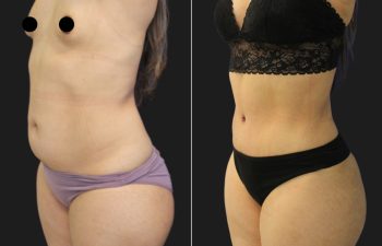 33 year-old before and 7 Weeks After Mommy Makeover (Tummy Tuck; Liposuction of Flanks, Lower Back, Upper Back, Hips, and Arms; Fat grafting to Buttocks; Breast Augmentation w/ Silicone Implants)