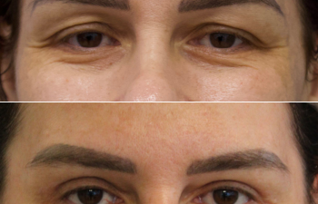44 year-old before and 11 months after an upper eyelid lift