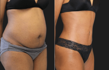 Comparación antes y después de un torso que muestra un contorno abdominal significativo, donde la imagen de la izquierda muestra exceso de piel y grasa y la imagen de la derecha muestra un abdomen más suave y tonificado.