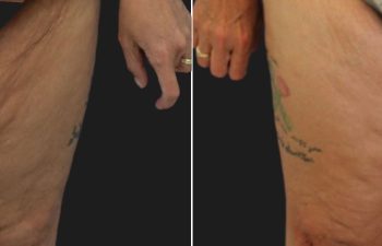 53 year-old before and 1 year after fleur-de-lis tummy tuck, flank liposuction, and thigh lift